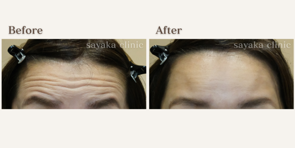 ボトックス注入後の症例写真